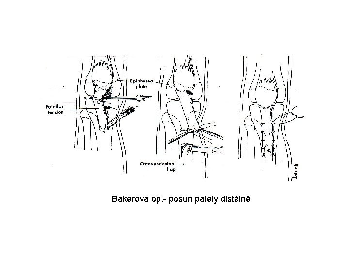 Bakerova op. - posun pately distálně 