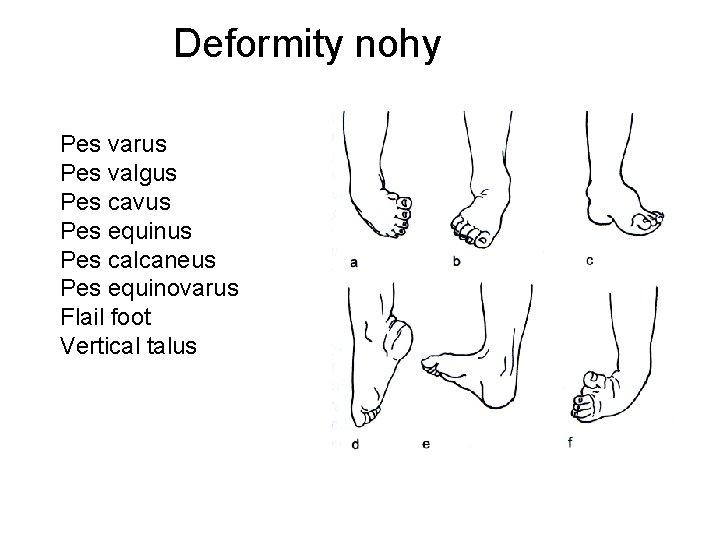 Deformity nohy Pes varus Pes valgus Pes cavus Pes equinus Pes calcaneus Pes equinovarus