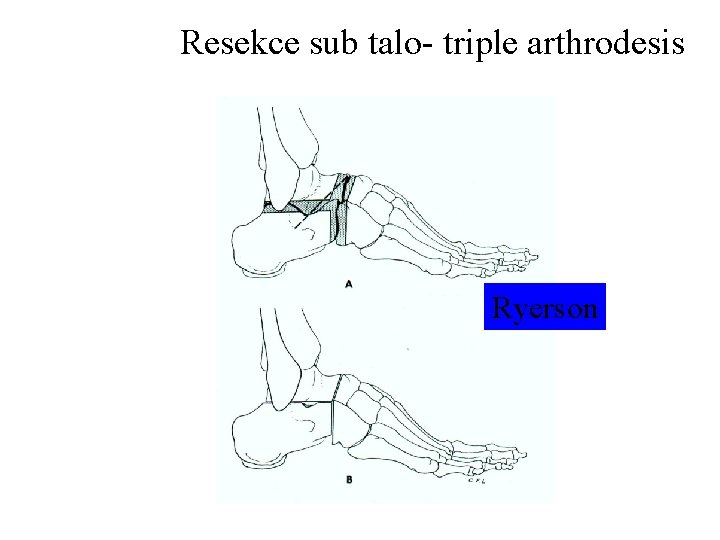 Resekce sub talo- triple arthrodesis Ryerson 