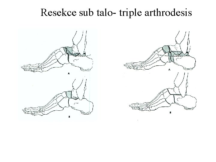 Resekce sub talo- triple arthrodesis 