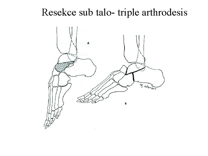 Resekce sub talo- triple arthrodesis 