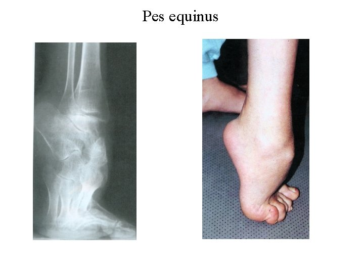 Pes equinus 