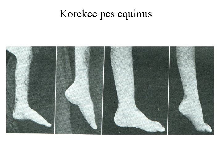 Korekce pes equinus 