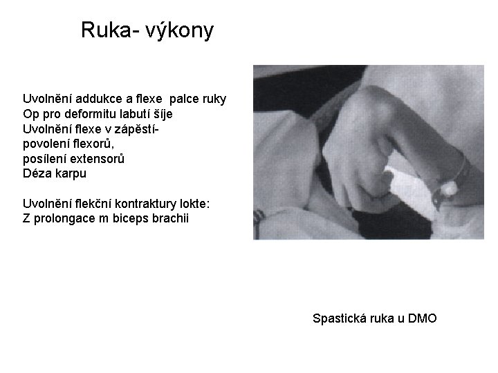 Ruka- výkony Uvolnění addukce a flexe palce ruky Op pro deformitu labutí šíje Uvolnění