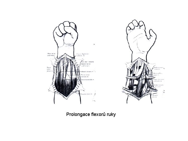 Prolongace flexorů ruky 