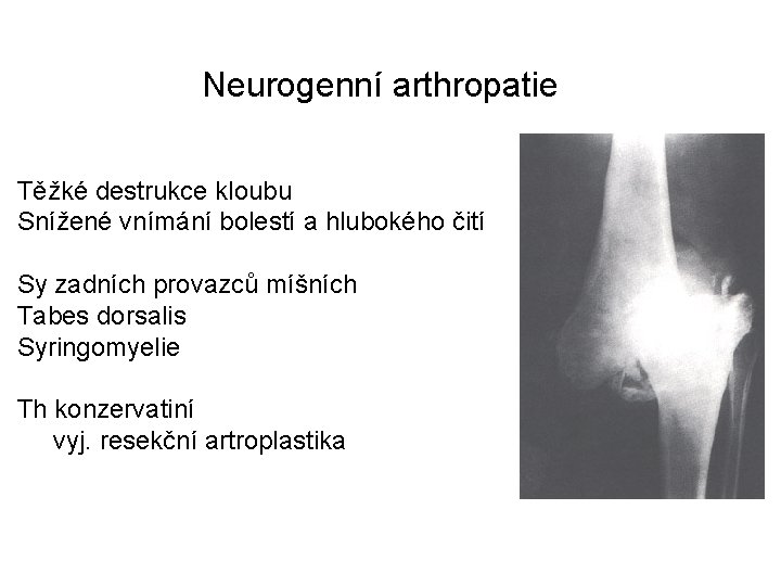Neurogenní arthropatie Těžké destrukce kloubu Snížené vnímání bolestí a hlubokého čití Sy zadních provazců