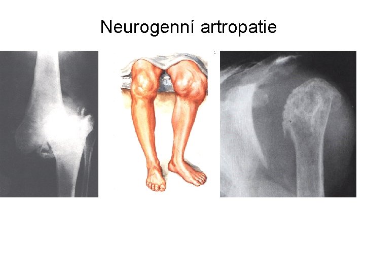 Neurogenní artropatie 