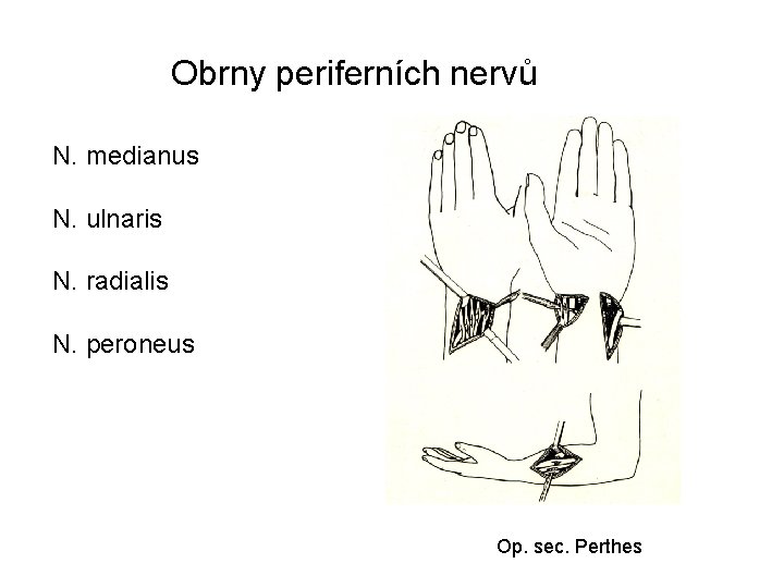 Obrny periferních nervů N. medianus N. ulnaris N. radialis N. peroneus Op. sec. Perthes