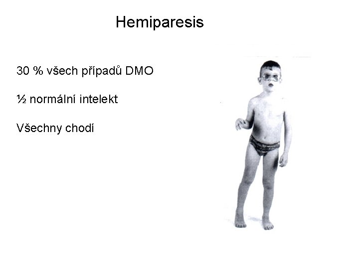 Hemiparesis 30 % všech případů DMO ½ normální intelekt Všechny chodí 
