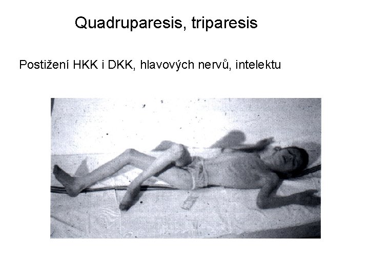 Quadruparesis, triparesis Postižení HKK i DKK, hlavových nervů, intelektu 
