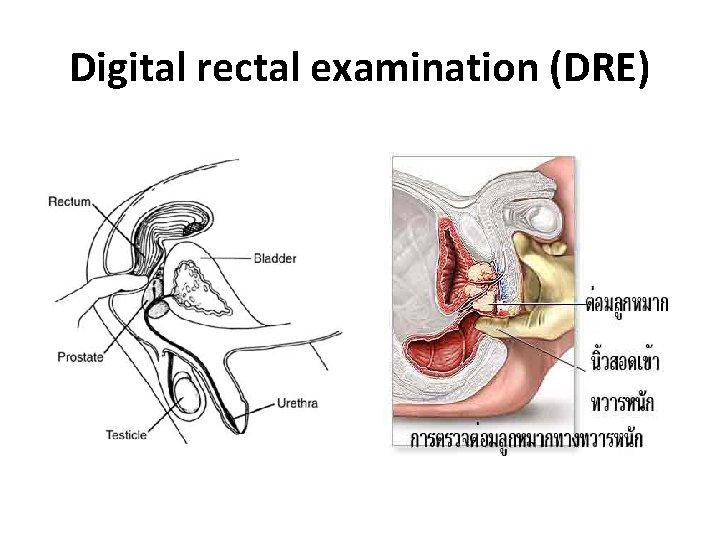Digital rectal examination (DRE) 