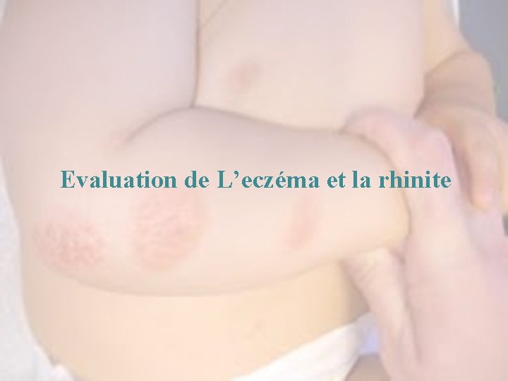 Evaluation de L’eczéma et la rhinite 