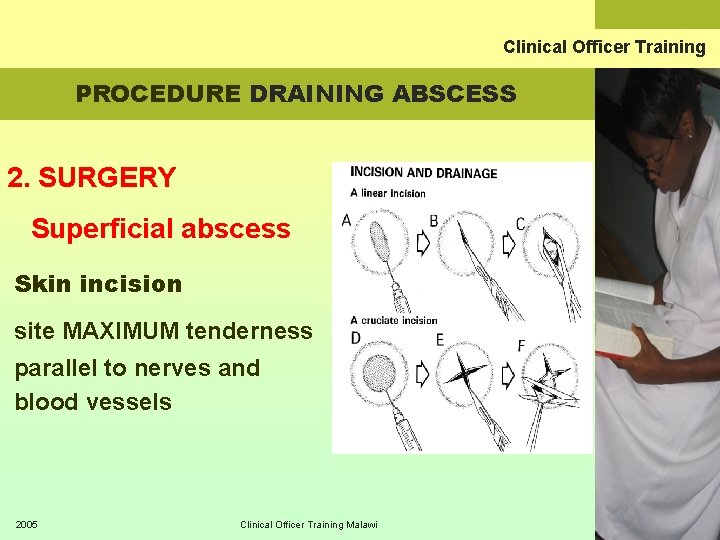 Clinical Officer Training PROCEDURE DRAINING ABSCESS 2. SURGERY Superficial abscess Skin incision site MAXIMUM