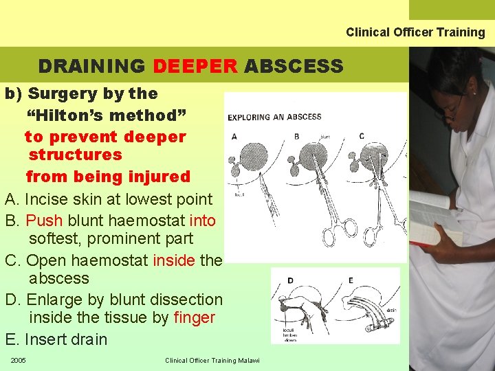 Clinical Officer Training DRAINING DEEPER ABSCESS b) Surgery by the “Hilton’s method” to prevent