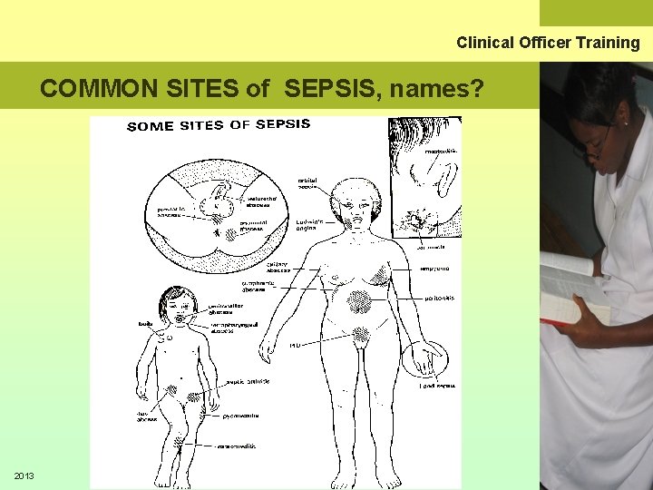 Clinical Officer Training COMMON SITES of SEPSIS, names? 2013 Clinical Officer Training Malawi 