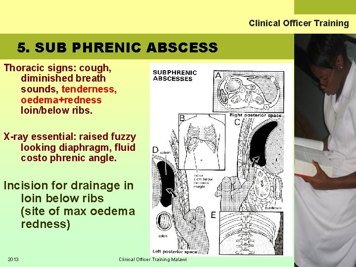 Clinical Officer Training 5. SUB PHRENIC ABSCESS Thoracic signs: cough, diminished breath sounds, tenderness,