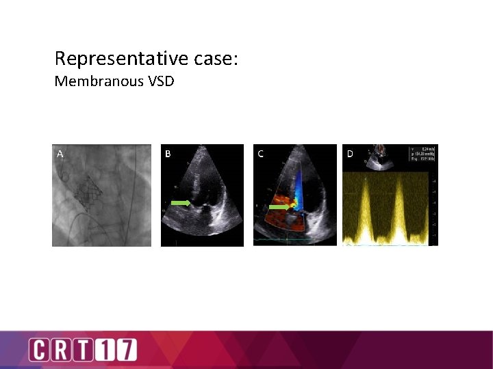 Representative case: Membranous VSD 