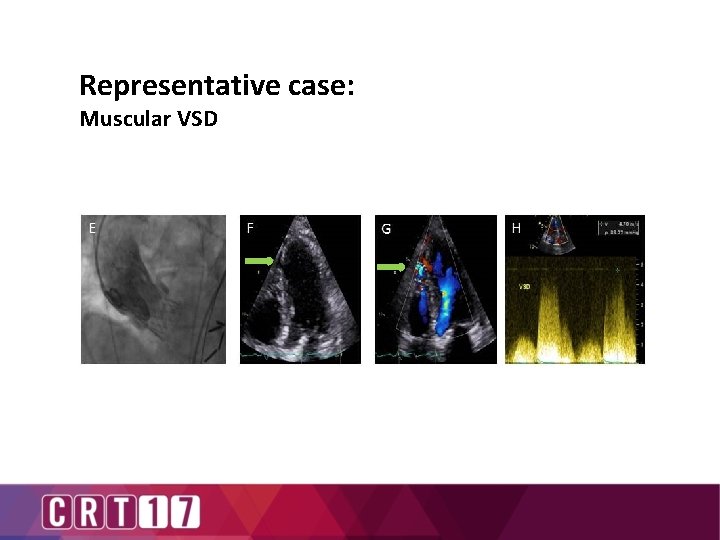 Representative case: Muscular VSD 