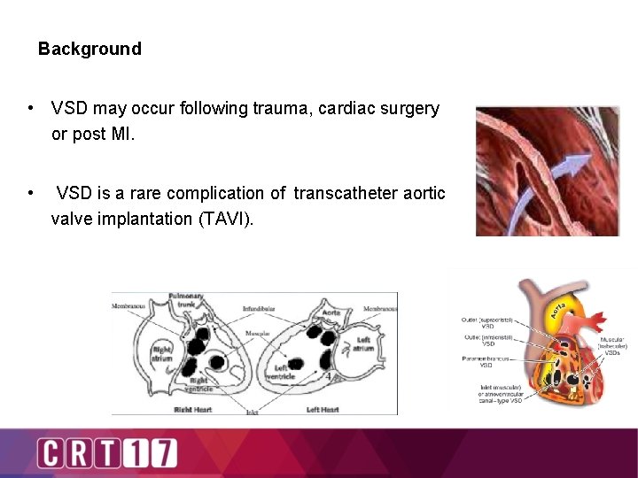 Background • VSD may occur following trauma, cardiac surgery or post MI. • VSD