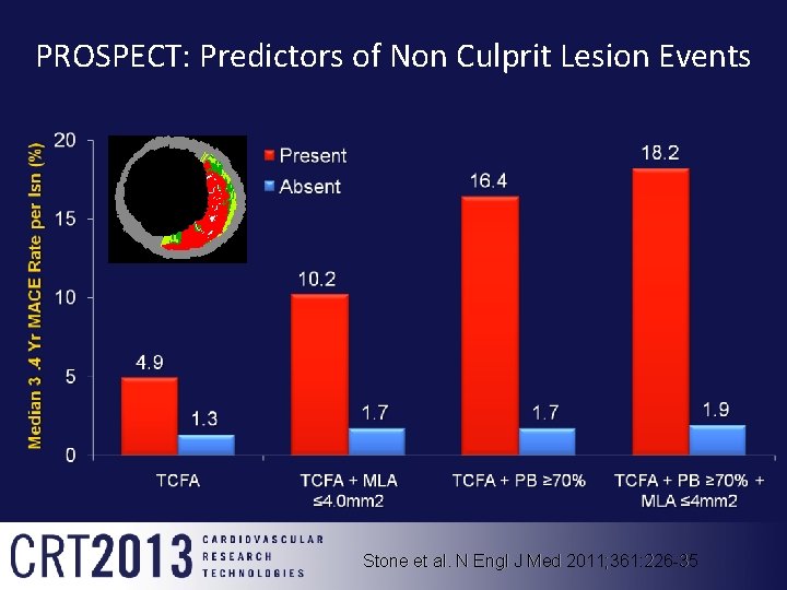 PROSPECT: Predictors of Non Culprit Lesion Events Stone et al. N Engl J Med