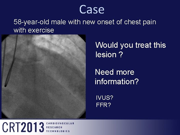 Case 58 -year-old male with new onset of chest pain with exercise Would you