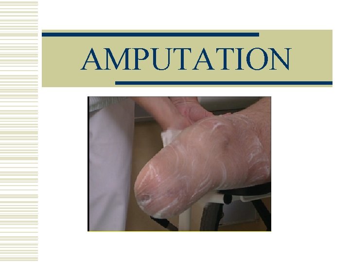 AMPUTATION 