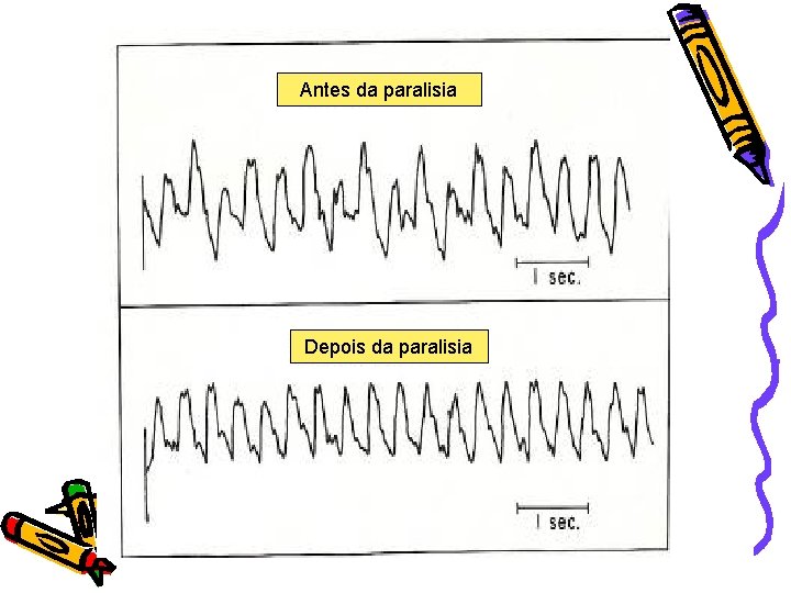 Antes da paralisia Depois da paralisia 