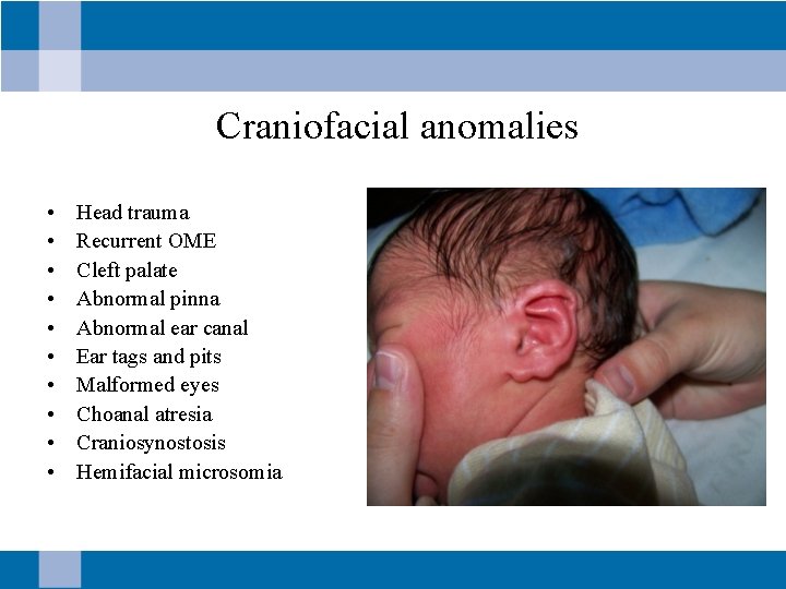 Craniofacial anomalies • • • Head trauma Recurrent OME Cleft palate Abnormal pinna Abnormal