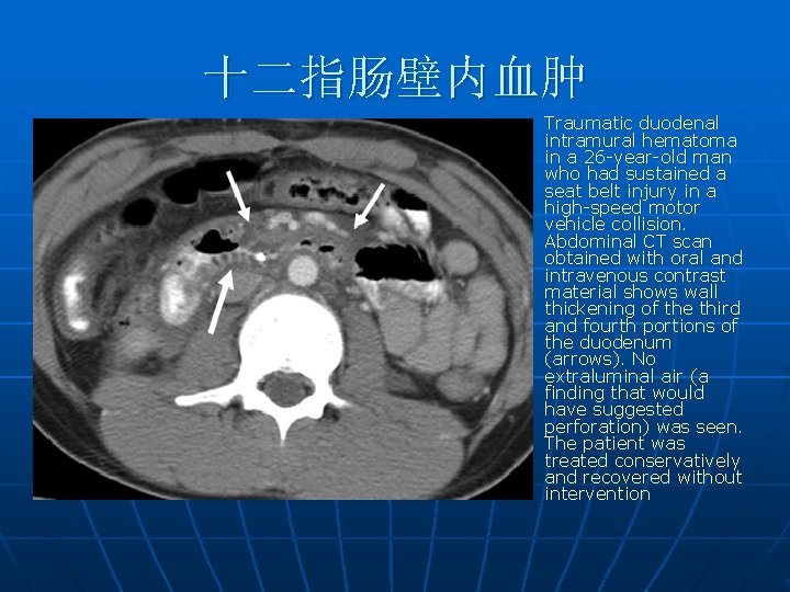 十二指肠壁内血肿 n Traumatic duodenal intramural hematoma in a 26 -year-old man who had sustained