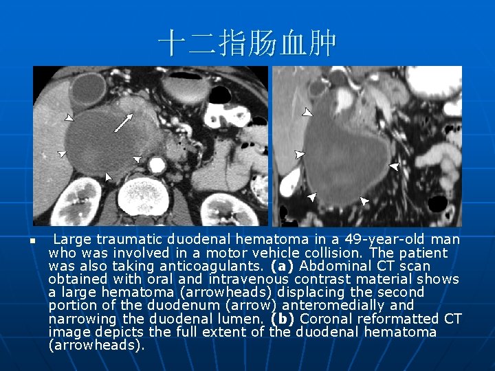 十二指肠血肿 n Large traumatic duodenal hematoma in a 49 -year-old man who was involved