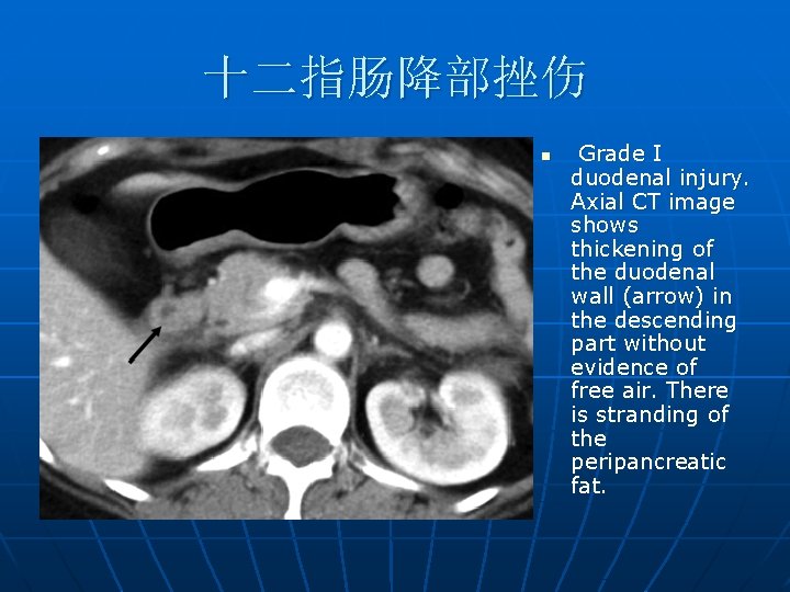 十二指肠降部挫伤 n Grade I duodenal injury. Axial CT image shows thickening of the duodenal