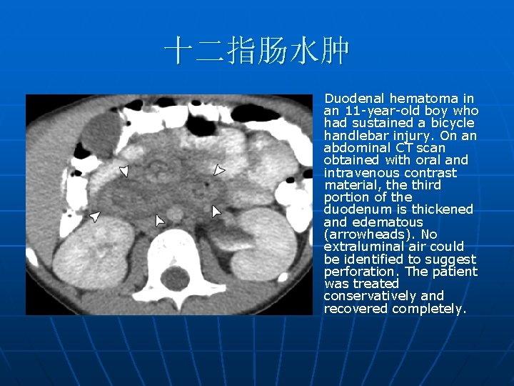 十二指肠水肿 n Duodenal hematoma in an 11 -year-old boy who had sustained a bicycle