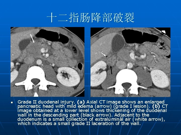 十二指肠降部破裂 n Grade II duodenal injury. (a) Axial CT image shows an enlarged pancreatic