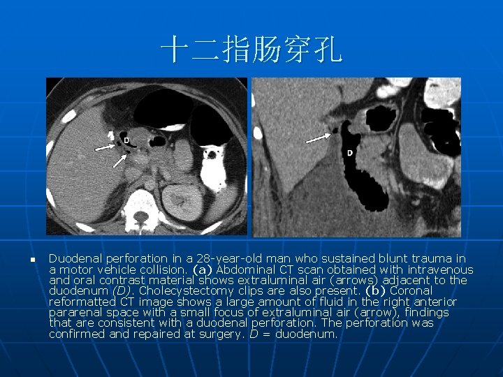 十二指肠穿孔 n Duodenal perforation in a 28 -year-old man who sustained blunt trauma in