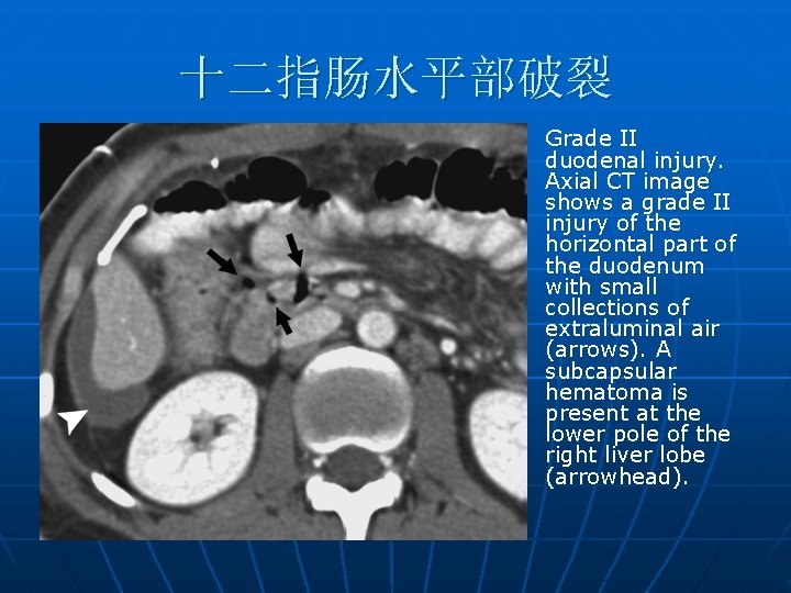 十二指肠水平部破裂 n Grade II duodenal injury. Axial CT image shows a grade II injury