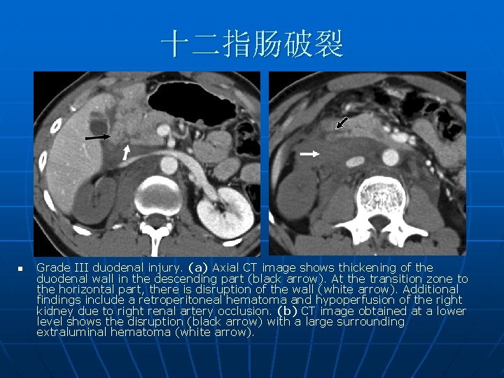 十二指肠破裂 n Grade III duodenal injury. (a) Axial CT image shows thickening of the