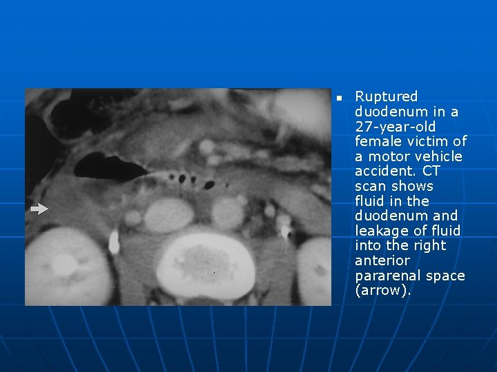 n Ruptured duodenum in a 27 -year-old female victim of a motor vehicle accident.