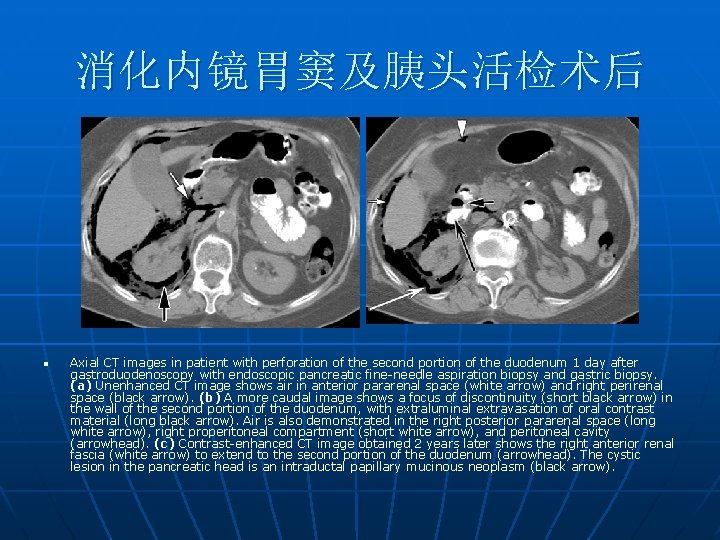 消化内镜胃窦及胰头活检术后 n Axial CT images in patient with perforation of the second portion of