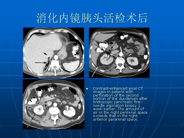 消化内镜胰头活检术后 n Contrast-enhanced axial CT images in patient with perforation of the second portion