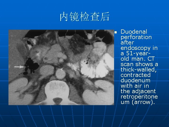 内镜检查后 n Duodenal perforation after endoscopy in a 51 -yearold man. CT scan shows