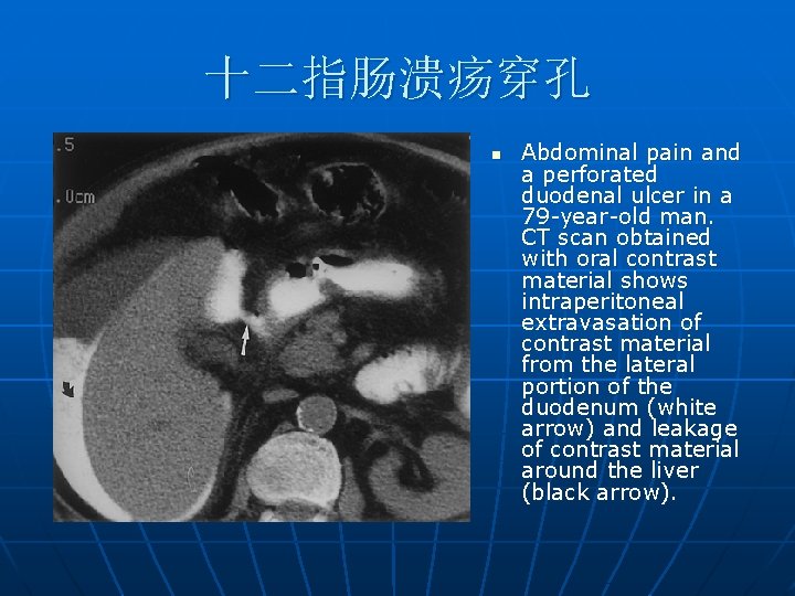 十二指肠溃疡穿孔 n Abdominal pain and a perforated duodenal ulcer in a 79 -year-old man.