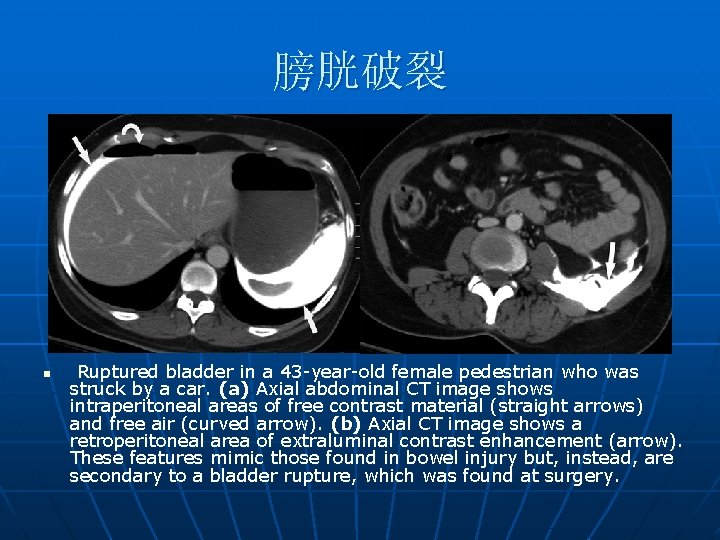 膀胱破裂 n Ruptured bladder in a 43 -year-old female pedestrian who was struck by