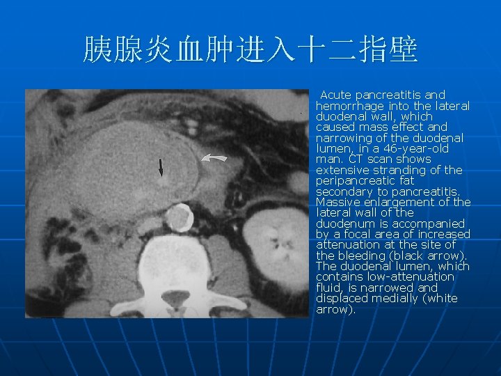 胰腺炎血肿进入十二指壁 n Acute pancreatitis and hemorrhage into the lateral duodenal wall, which caused mass