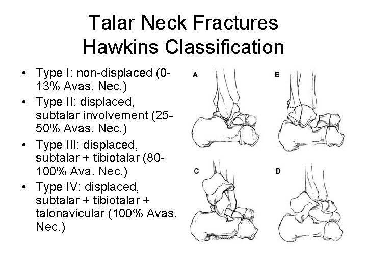 Talar Neck Fractures Hawkins Classification • Type I: non-displaced (013% Avas. Nec. ) •