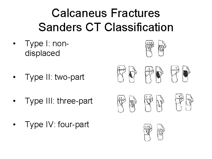 Calcaneus Fractures Sanders CT Classification • Type I: nondisplaced • Type II: two-part •