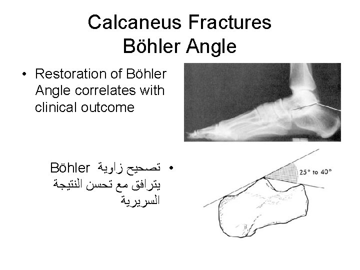 Calcaneus Fractures Böhler Angle • Restoration of Böhler Angle correlates with clinical outcome Böhler