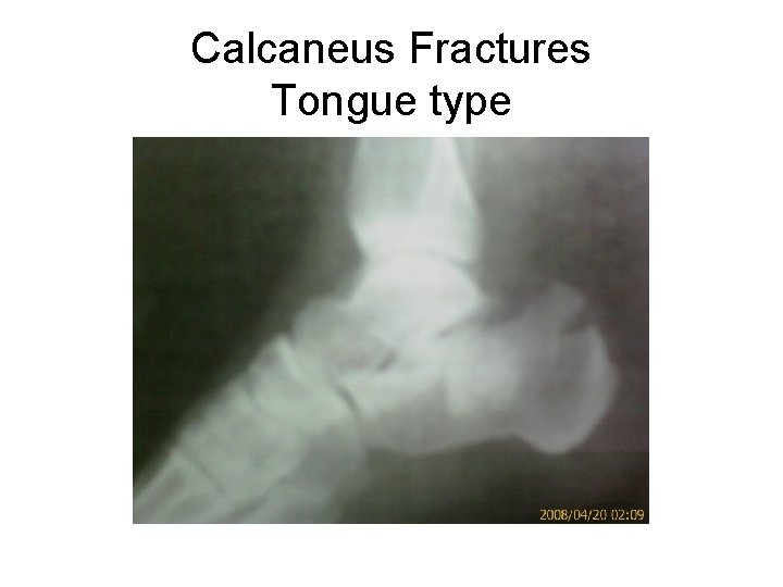Calcaneus Fractures Tongue type 