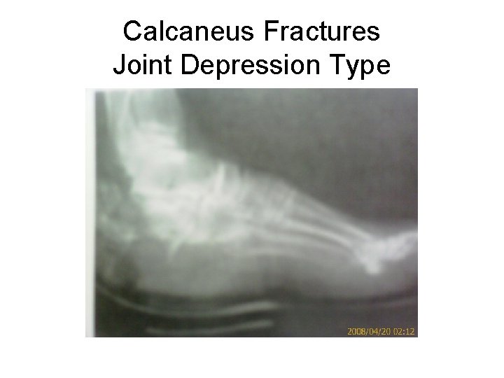 Calcaneus Fractures Joint Depression Type 