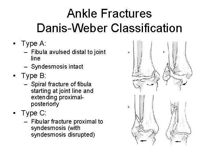Ankle Fractures Danis-Weber Classification • Type A: – Fibula avulsed distal to joint line