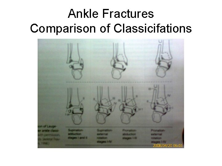 Ankle Fractures Comparison of Classicifations 